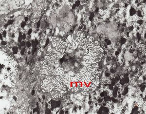 F,7m. | giant cell hepatitis F,7m. | giant cell hepatitis
